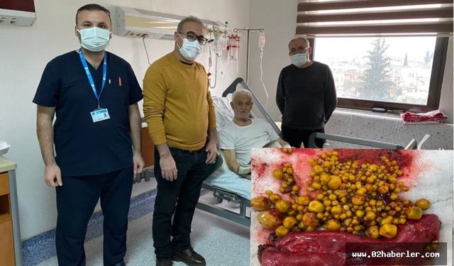 81 Yaşındaki Hastanın Safra Kesesinden çok Sayıda Taş çıkarıldı